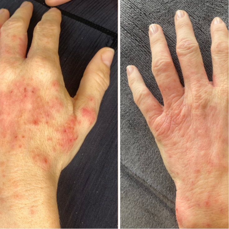 What skin conditions can red light therapy treat?