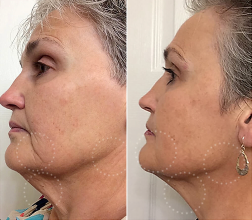 Red Light Therapy for Anti-Aging